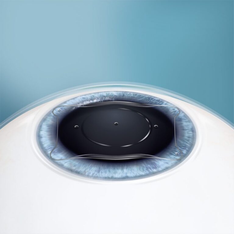Illustration: Die ICL liegt entfaltet vor der Iris, über der weiten Pupille