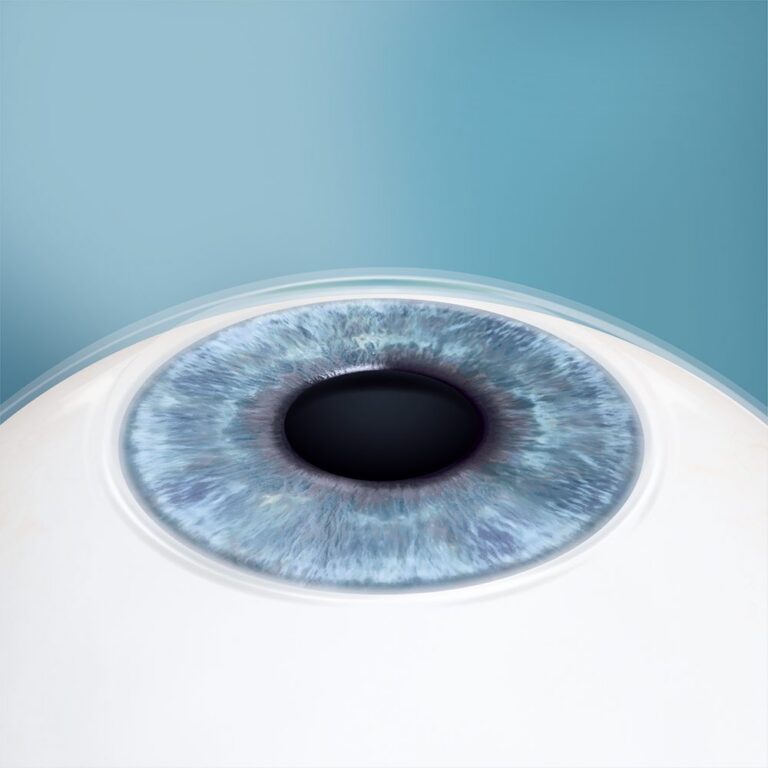 Illustration: Auge nach dem Eingriff mit enger Pupille, die Linse ist von aussen nicht zu sehen